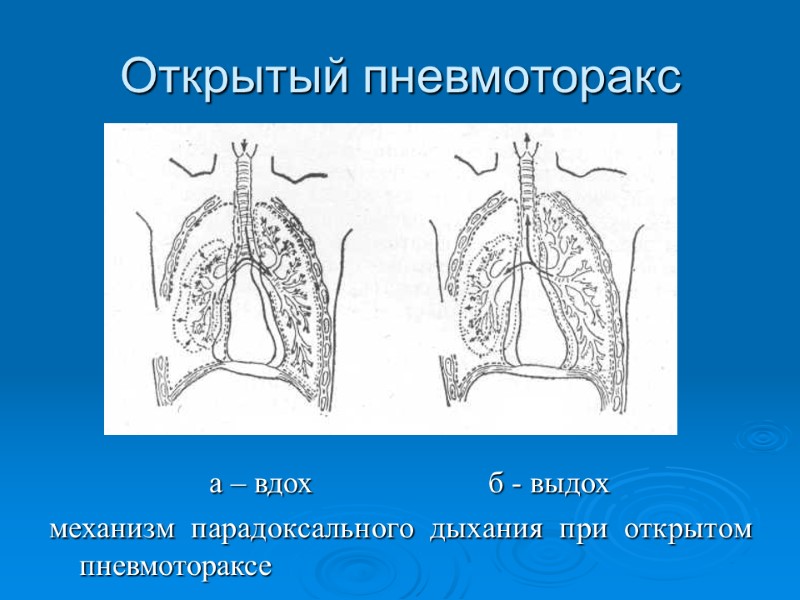 Открытый пневмоторакс    а – вдох      